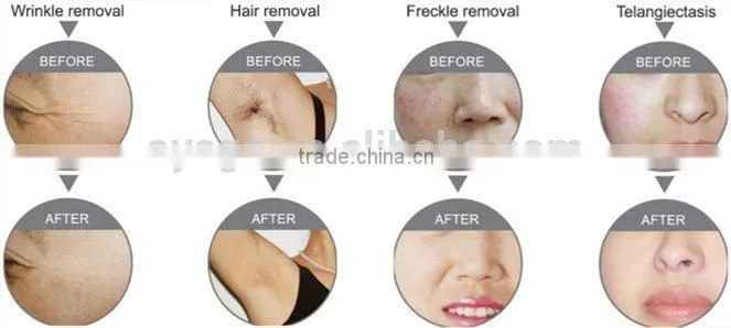 GIR-10 IPL machine with high quality/IPL hair removal & skin rejuvenation machine