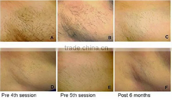 Best quality handheld hair removal laser portable/hair removing laser home