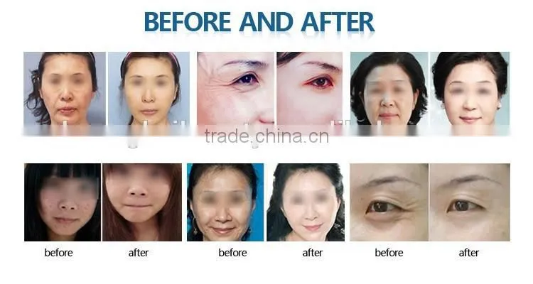 most popular oxygen therapy machine Skin Rejuvenation/ skin whitening