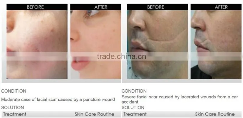 540 derma roller
