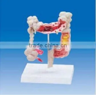 Colon and rectum model ,Colon and rectum common disease model