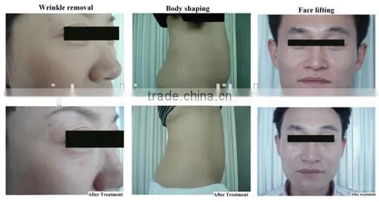 Aesthetic Equipment Ultrasonic Cavitation RF Vacuum Roller Massage body shaping machine