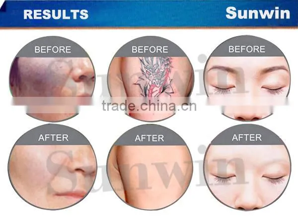 Sunwin SW-005E professional laser tattoo removal machine