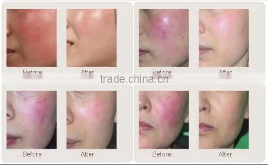 Diode laser 980nm vascular machine for spider vein removal