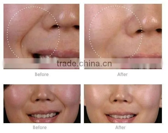 rf co2 fractional laser
