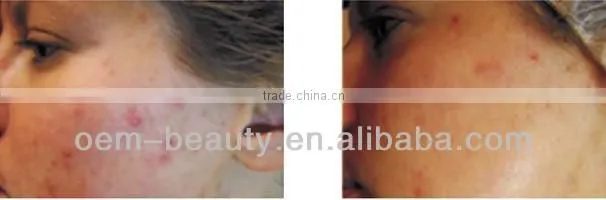 Medical CE IPL hair removal machine pigment acne treatment