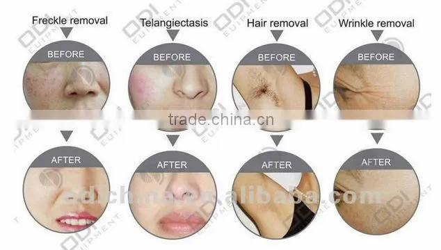Hot Sale OD mini 60 Shr Anti Redness hair removal freckle removal portable mini ipl