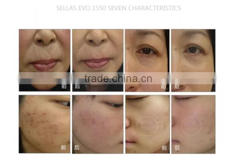 1550nm Anti-Aging Laser Stretch Marks Elimination Rejuvenation Therapy Machine 1550nm laser fiber laser machine