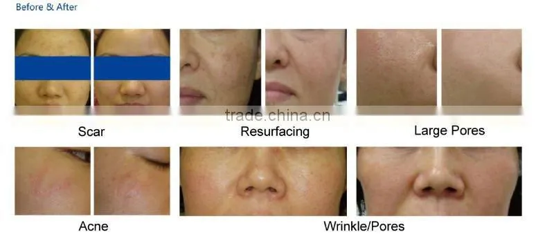 RF Excited Fractional CO2 Laser/ CO2 fractional laser