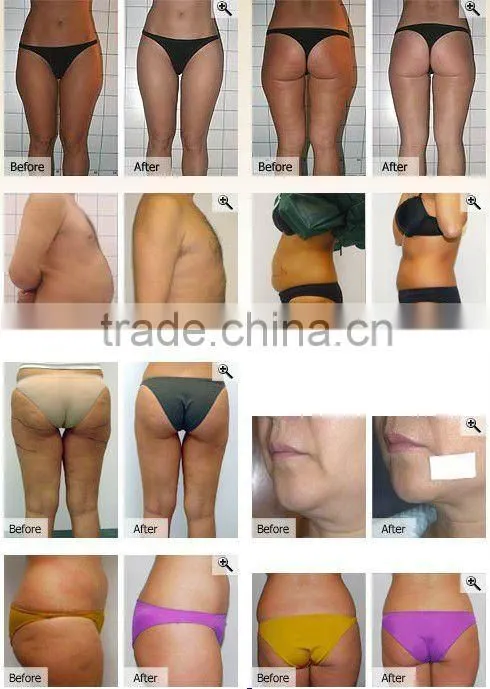 2012 Cyclone RF Slimming Beauty Machine