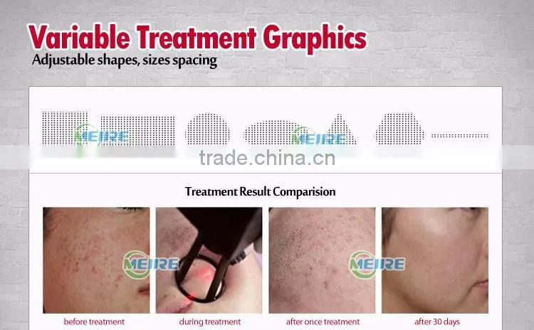 Factory price CE approved fractional co2 laser scar removal glass tube fractional co2 laser