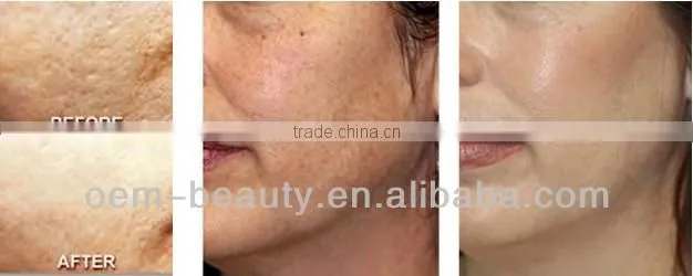 Sale! Intese pulse ipl laser machine hair reduction ipl machine