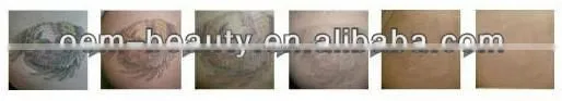 Newest laser tattoo removal machine permanent and pain free tattoo removal