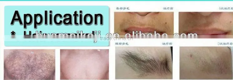NEW 808nm diode laser for permanent unwanted hair removal