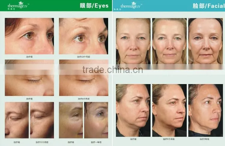 radio frequency facial massage