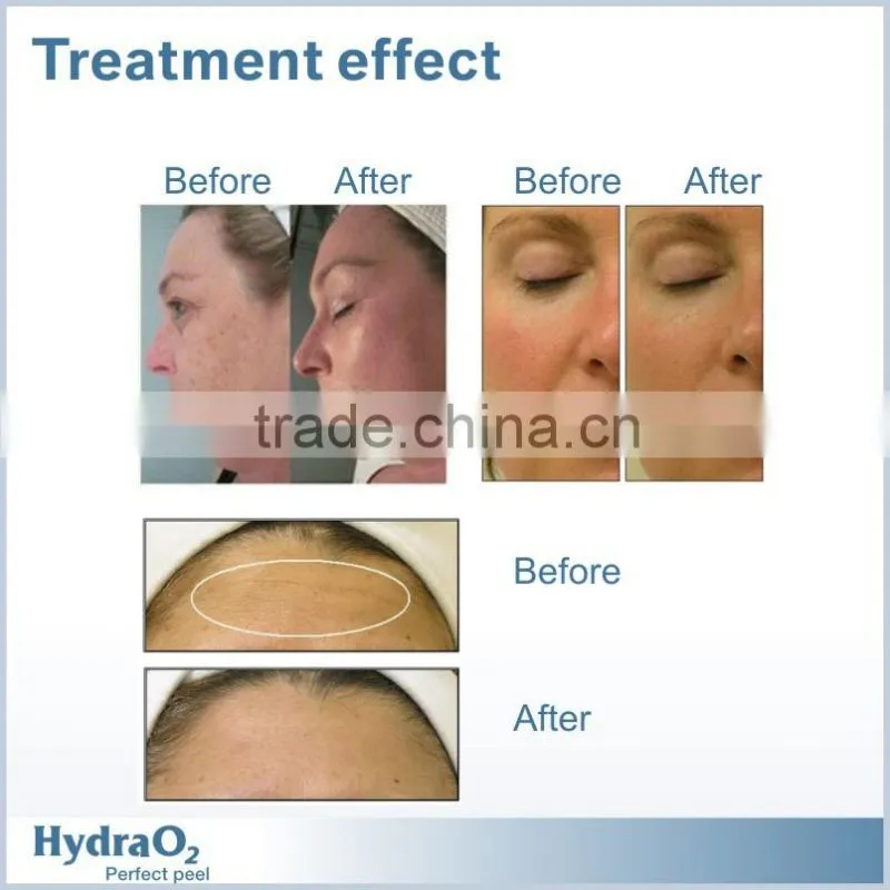 2015 New water dermabrasion machine oxygen therapy skin beauty