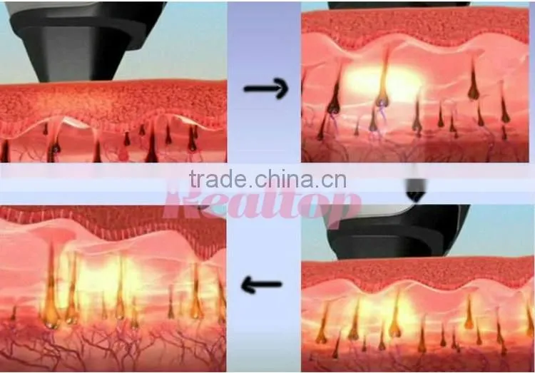 Hi-tech laser depilacion /depilacion system best 808 diode hair removal treatment laser /maquinas de depilacion laser diodo
