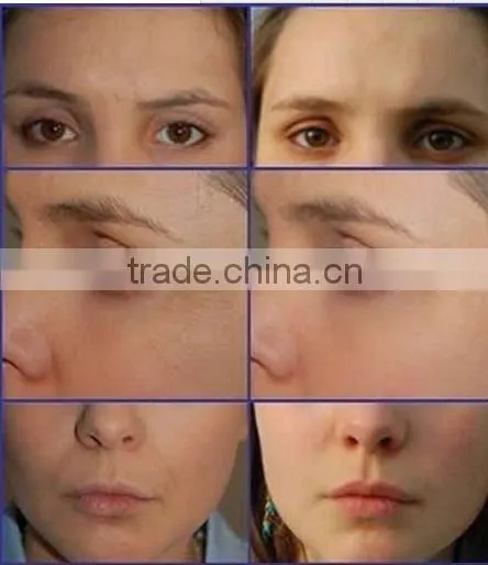 2015 Hot Sale !!! NL-SK2 PDT led phototherapy light equipment with multi-functions Beauty Mahcine 2015