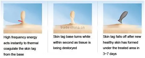 Instaneous High frequency facial mole removal