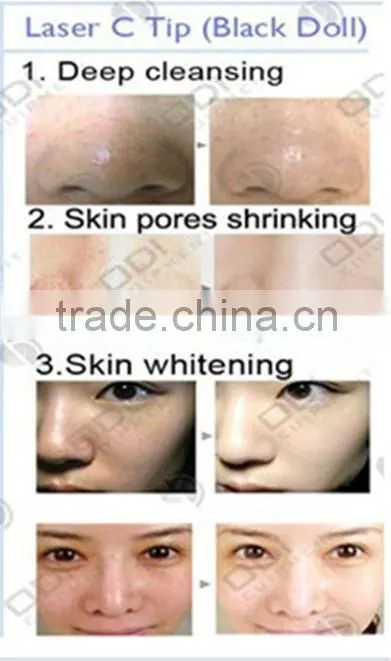 China Factory Best Black Doll skin rejuvenationcarbon powder 50g acne treatment laser Carbon lotion