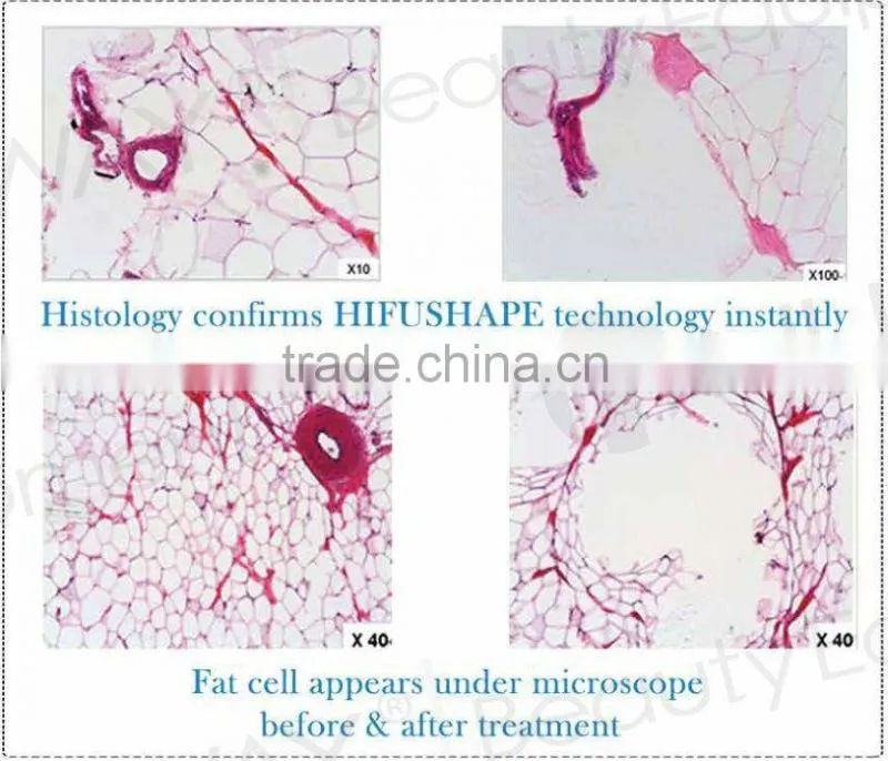 New fat reduction equipment hifu liposonix fat reduce machine