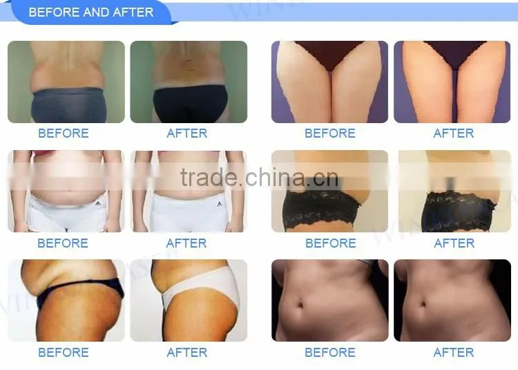 High intensity 2 years warranty focused ultrasound hifu liposonix device for weight loss