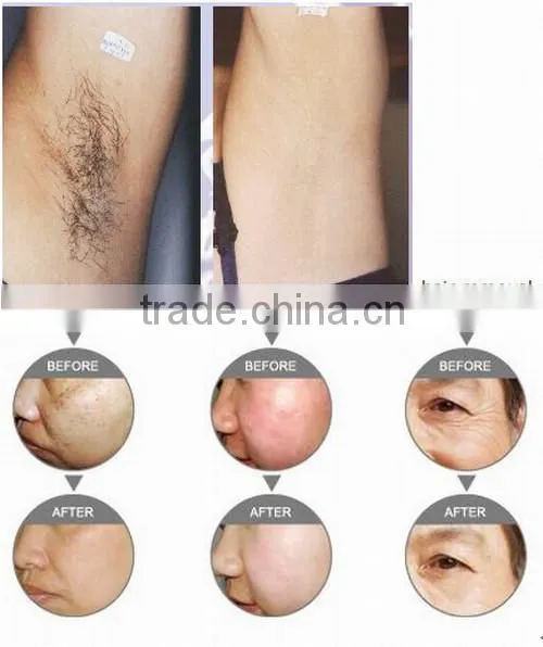 Heta F-9008A high quality elight shr beauty salon equipment hair removal