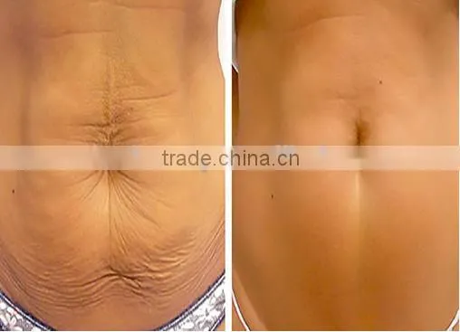 Best cavitation rf tightening skin rejuvenation anti aging machine