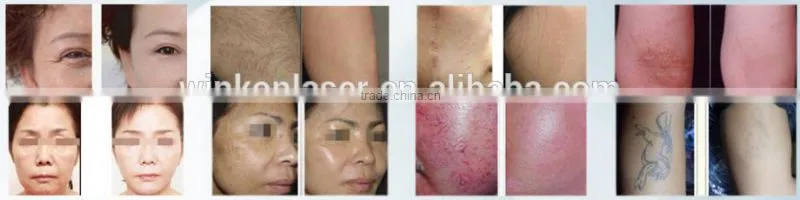 portable ipl / xenon lamps for ipl / home ipl