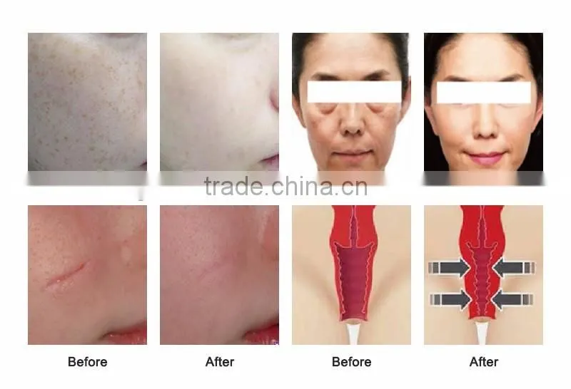 US RF pipe 40W co2 laser acne scar removal and laser skin laser resurfacing machine