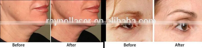 2015 New Product Medical CE Approval Microneedle Fractional RF for Skin Rejuvenation