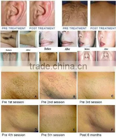 permanent hair removal / laser face hair removal machine