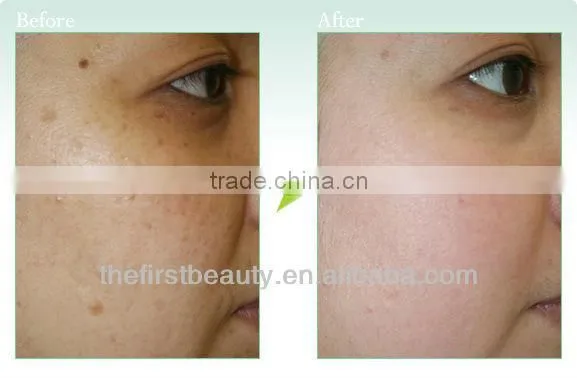 New design Skin lifting Derma roller 540 micro needle roller system with derma roller mts