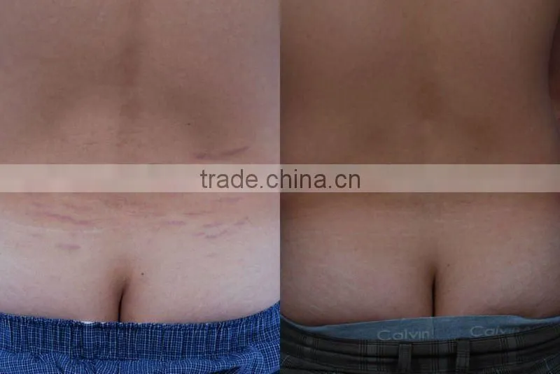The best dermaroller for stretch marks and acne scars L002