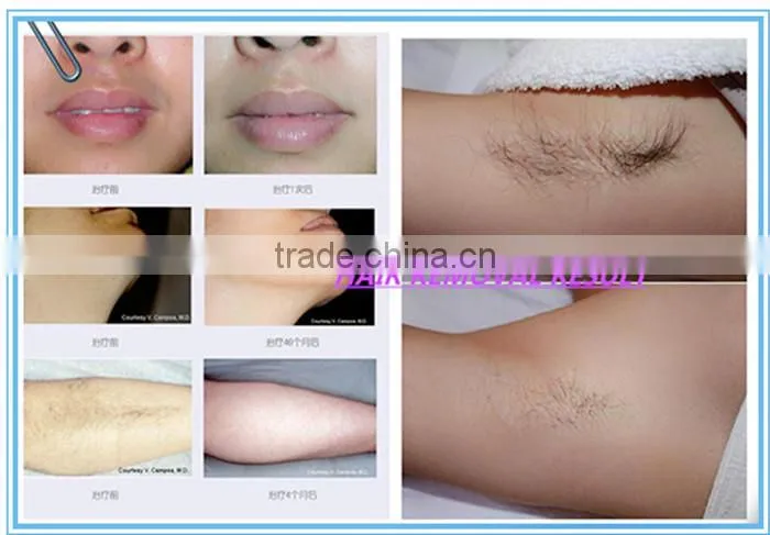 CE Approval Long pulse 1064nm nd yag laser permanent hair removal and Spider Vein removal