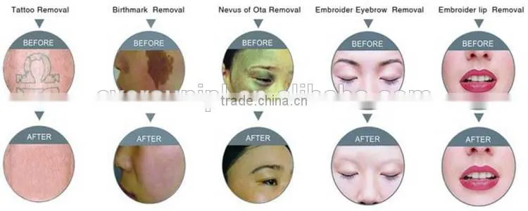 Q switch & Nd Yag laser tattoo removal 1064nm & 532nm with CE