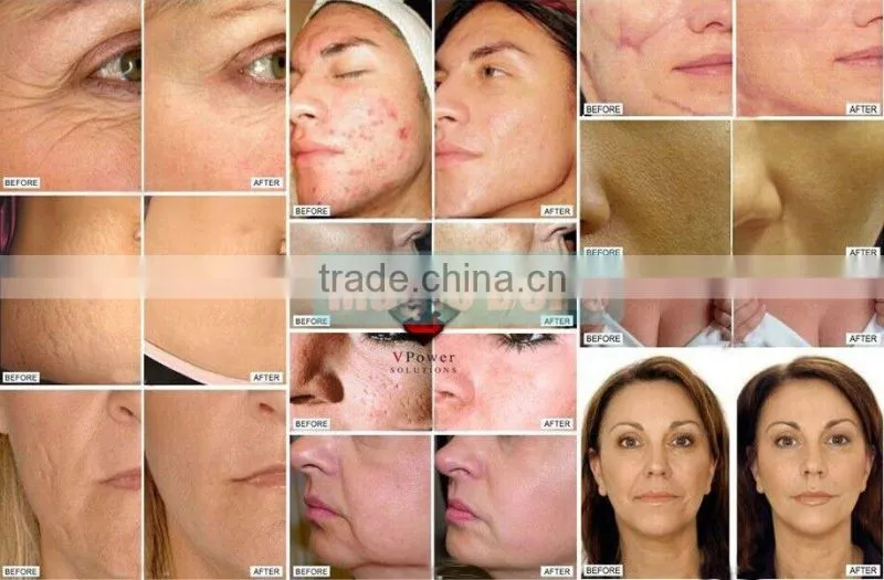 The Factory price!!!Omega Light in LED/4 color led light Therapy Machine/Omega Light PDT Therapy Machine