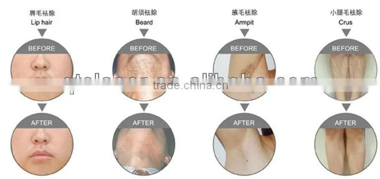 diode laser hair removal machine price/808 diode laser