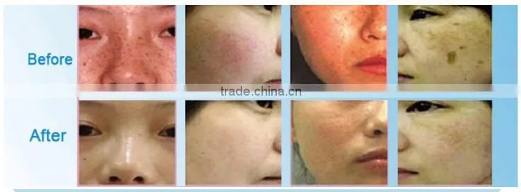 High Quality Water Oxygen Jet for Skin Care