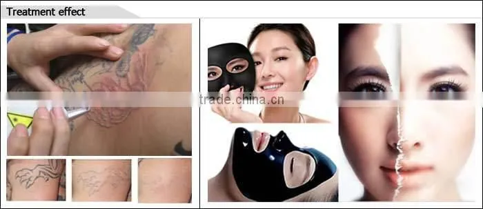 laser tatto removal machine/Yag laser tattoo laser beauty equipment