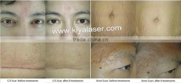 factory selling carboxytherapy co2 health & beauty system