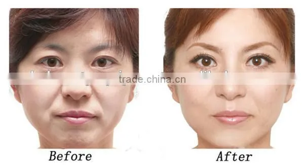 facial pore cleanser machine pore minimizer machine eye bag removal machine