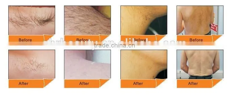 Hot sale Vertical 808nm Diode Laser Hair Removal