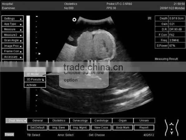 laptop ultrasound scanner with 3D function