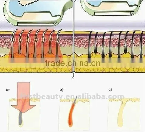 Hair removal ipl-- hair free intensive pulse light