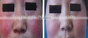 High energy Nd yag Laser /Cavitation / RF /E-light IPL Hair Removal