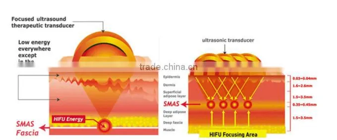 Wholesale skin tightening ultrasound hifu machine