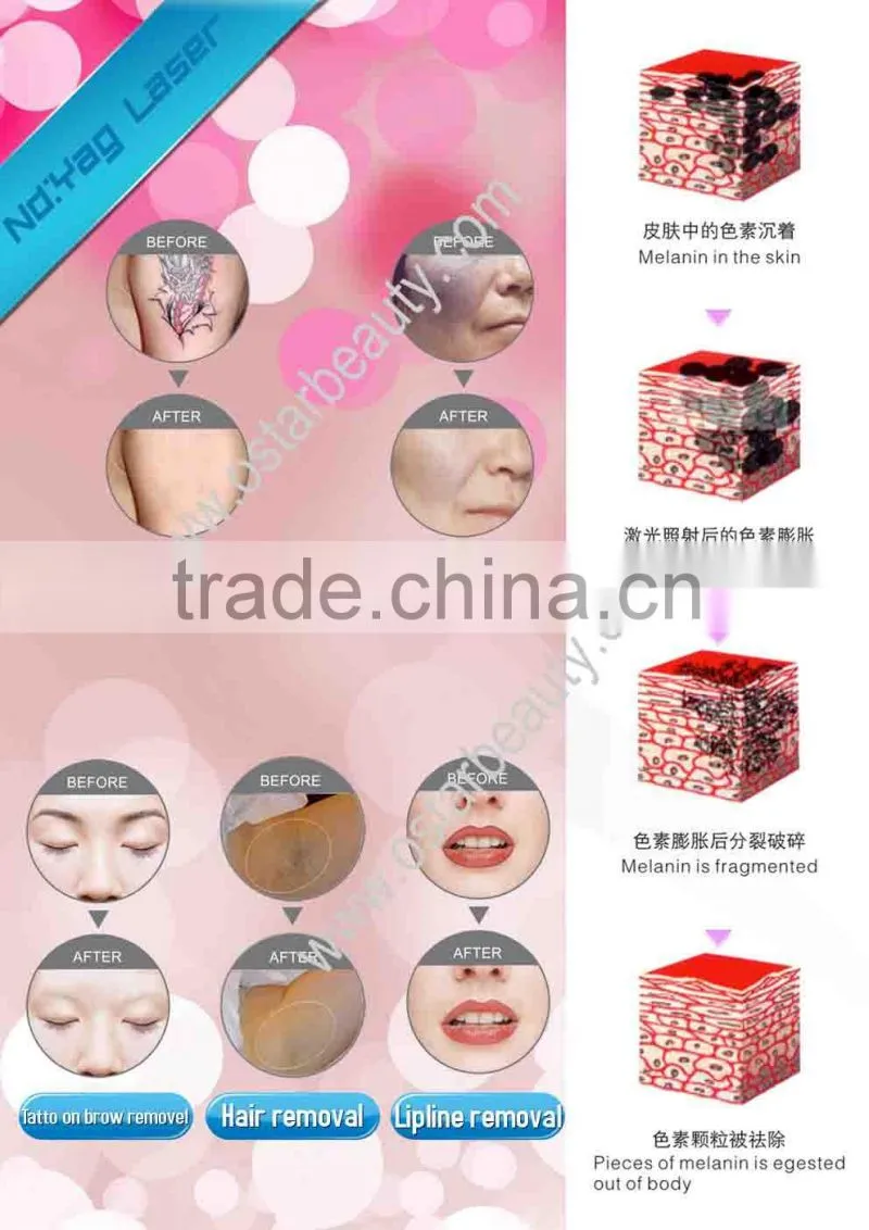 Q-switch Nd yag laser tattoo removal machine (Ostar Factory)