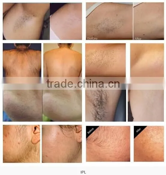 IPL Elight SHR RF Q Switched laser hair removal IPL laser with CE