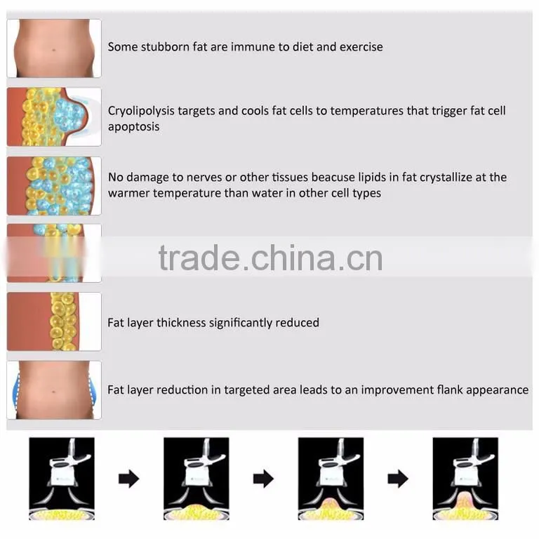 Multifunctional Cryolipolysis Device!!! Laser/RF/40K Cavitation Cryolipolysis Machine for Home Use